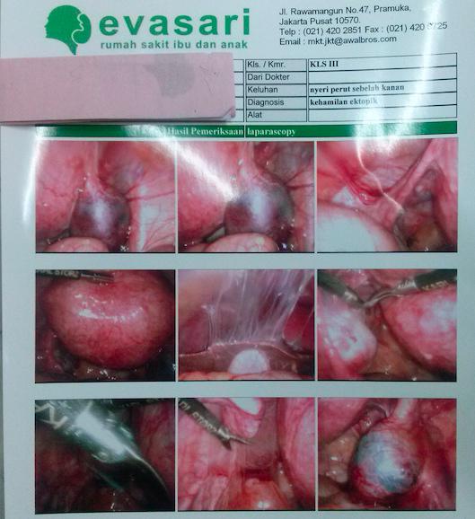 Laparoskopi Hamil Ektopik (Hamil di luar kandungan) @rsiaevasari