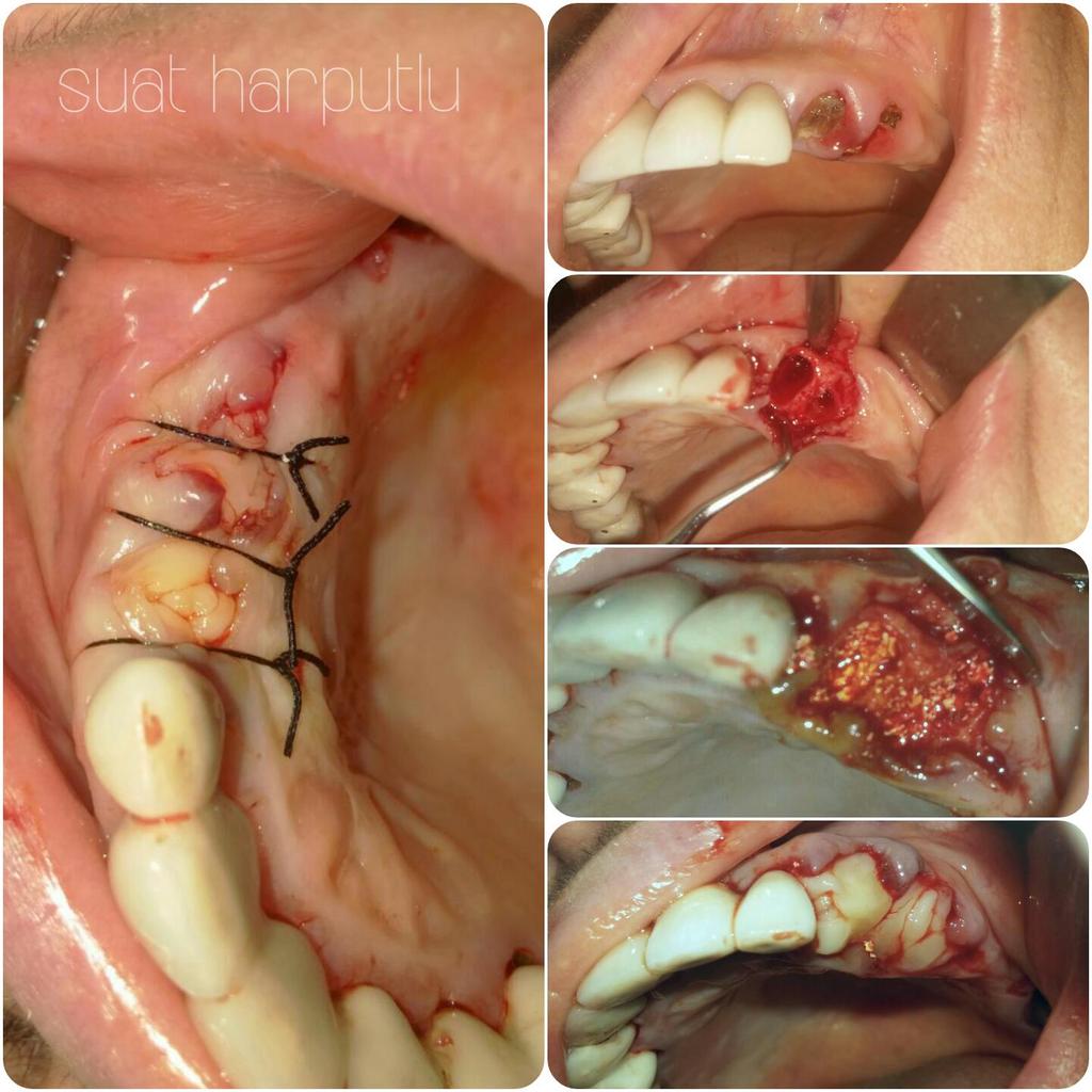 suatharputlu's tweet photo. afterextraction, #PRF use to treat socket with #biomaterial to prevent  #bone to be able to place #implant #dentistry http://t.co/cDf3Y2Xmbv
