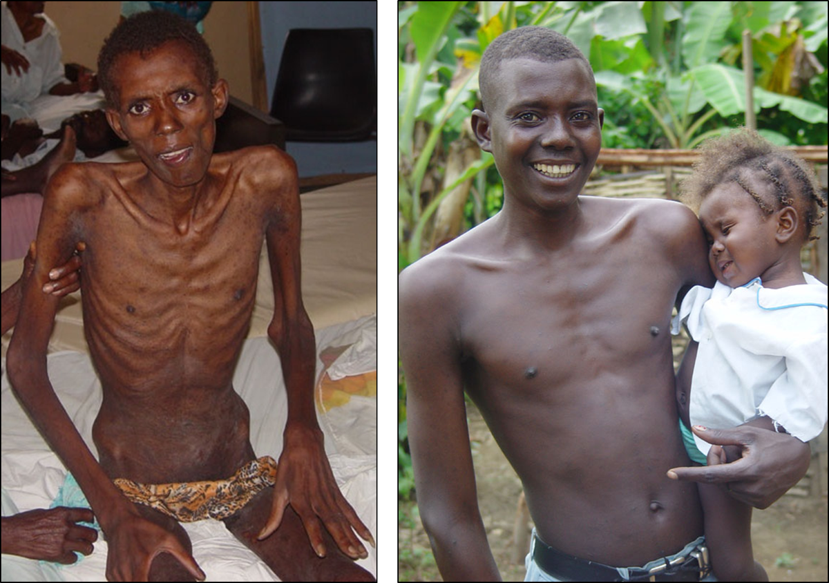 World Bank En Twitter Lazarus Effect Of Hiv Treatment Joseph Jeune From Haiti Before After Hiv Tb Treatment Guglobalfutures Http T Co 4dzjsalu3o