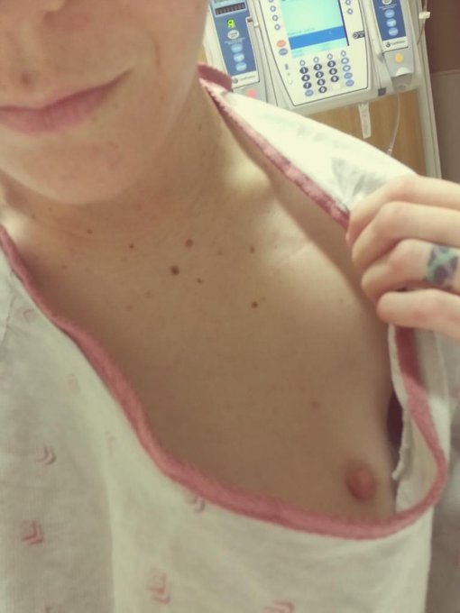 Stuck in the hospital a few days. Boredom = Nipple Peek! (My surgery scar is lookin' good, btw.) http://t<a href="/tag/mvsales"class="tags"><span>#mvsales</span></a>