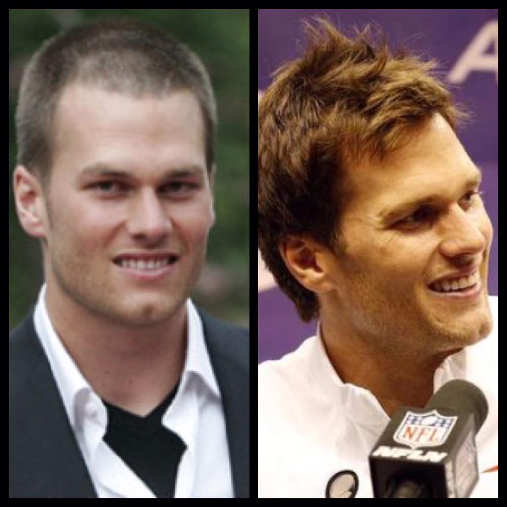 tom brady hair transplant before after