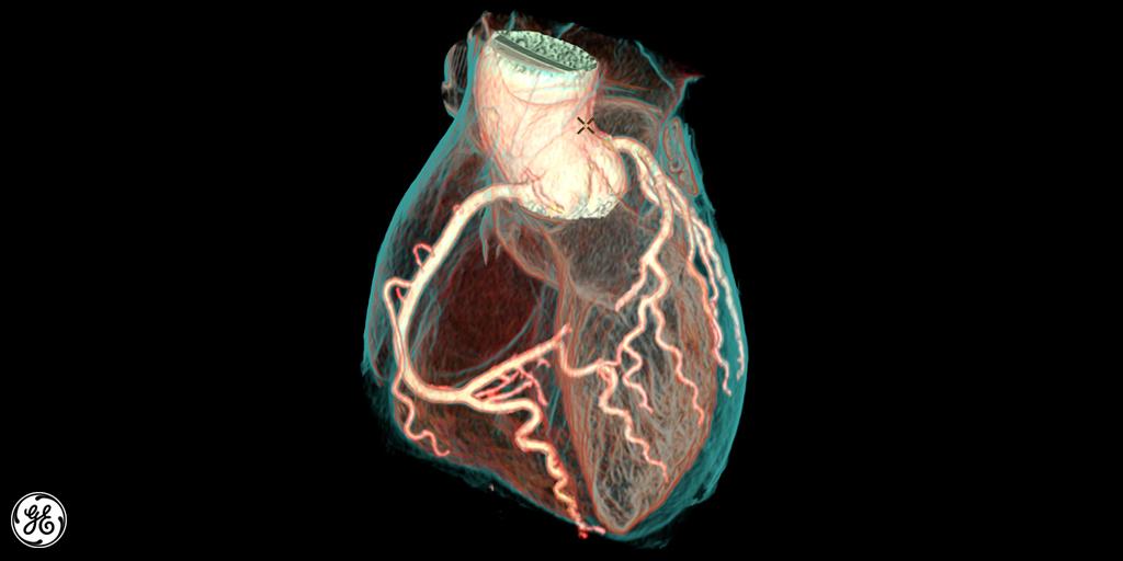 GEHealthCare's tweet photo. What if you could freeze a heartbeat in motion and see it in crystal-clear quality?  #ArabHealth #CTScan http://t.co/8Bn4Y8NrAK