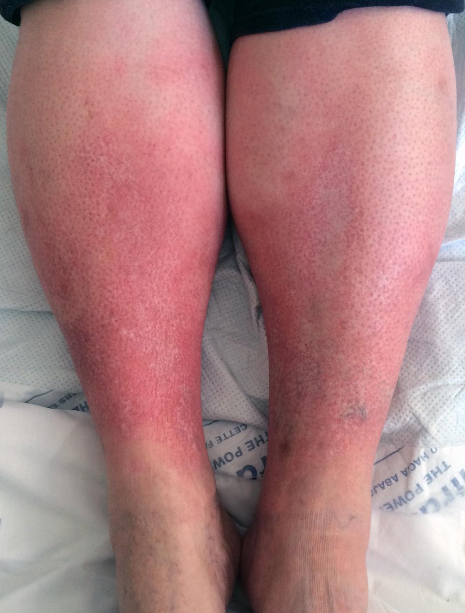 endocrinenetwrk's tweet photo. The "inverted champagne bottle" appearance of the lower leg is a sign of #lipodermatosclerosis http://t.co/p4OUpYhBMe http://t.co/MsZOtfGYu4
