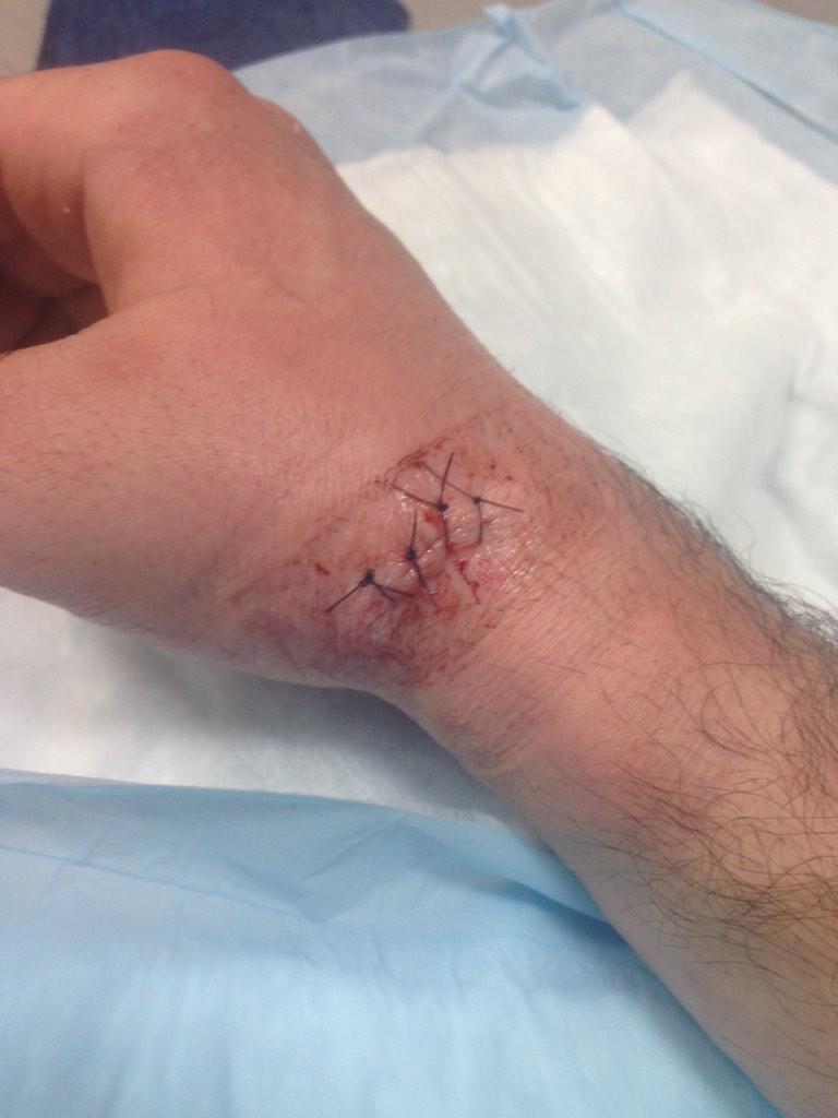 JakeJasper1's tweet photo. In red deer waiting on surgeon to figure out how to fix my hand up http://t.co/DuPyjDHIcW