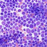 CanerOrgUa's tweet image. Острый лимфобластный #лейкоз - cancer.org.ua/oncohematology…

#новости #онкология #cancer