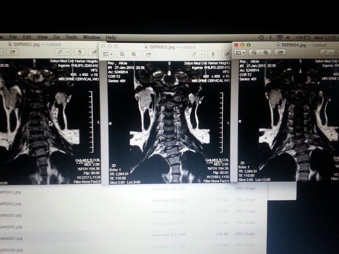 So I have a copy of my #MRI. I'm no radiologist, but I know my spine is not straight. Just upset about<a href="/tag/mri"class="tags">#MRI</a>