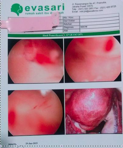 histeroskopi diagnostik... @rsiaevasari