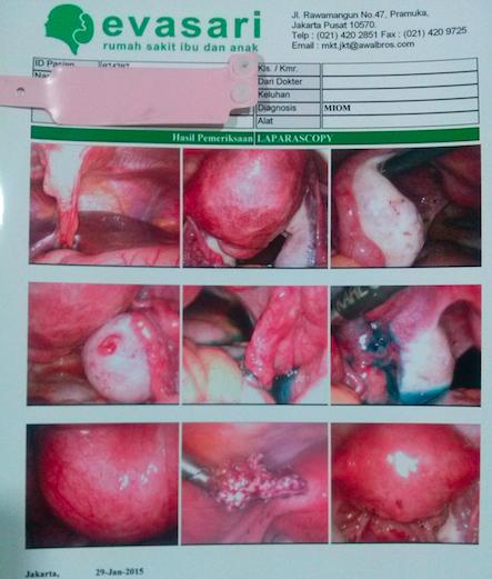 laparoskopi mioma uteri korpus belakang dan kromotubasi... @rsiaevasari