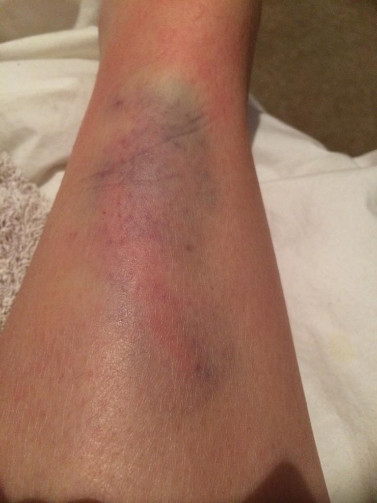 megan_ellie_m's tweet photo. When they say break a leg in theater, you shouldn't actually try to do it... #felldownstairs #clumbsypeopleproblems http://t.co/M8A8lwtjtO