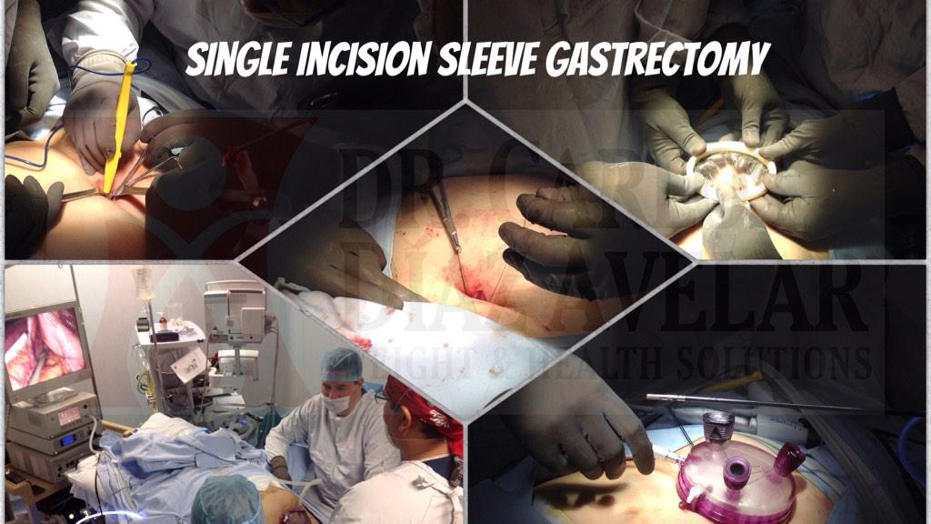 dr_diazavelar's tweet photo. #singleincision #laparoscopic #bariatric #surgery for#obesity #wls #vsg #singleport #verticalsleeve #gastrectomy #gdl http://t.co/Jpv0iqlV0r
