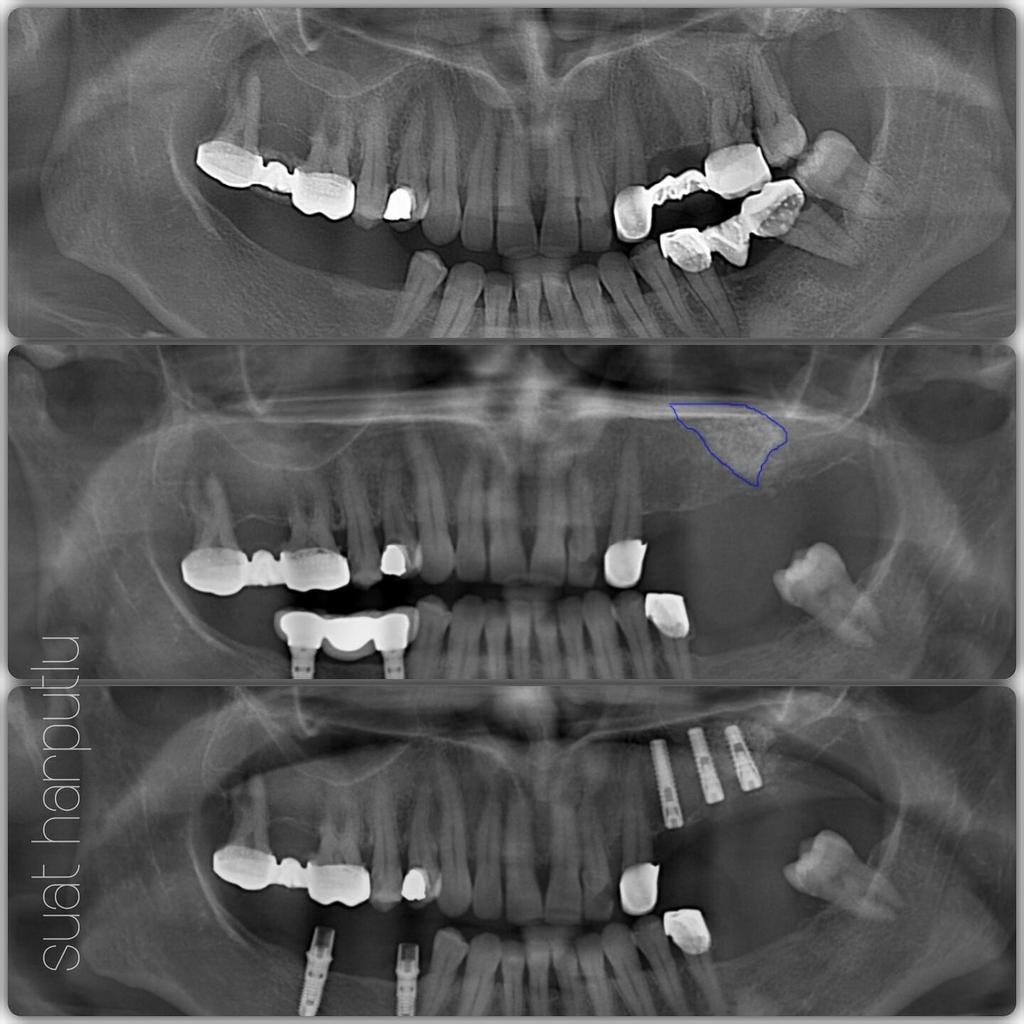 suatharputlu's tweet photo. #sinuslifting after 6 months later 3 #implant placement. #dentist #omf #dental #oralsurgery #dishekimi #dentalimplant http://t.co/W2LBsxkMIi