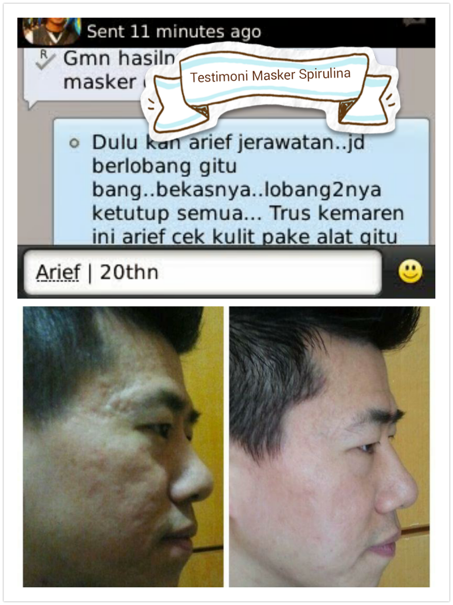 Referendum Rauw overstroming Herbal Cantik on Twitter: "Wajah Bopeng Karena Jerawat, mau mulus lagi? Coba Masker spirulina aja, Order hub pin:211F9F47 , Ph 0822 1640 1544 http://t.co/PSCLliJbTJ" / Twitter Referendum Rauw overstroming Herbal Cantik on Twitter: "Wajah Bopeng Karena Jerawat, mau mulus lagi? Coba Masker spirulina aja, Order hub pin:211F9F47 , Ph 0822 1640 1544 http://t.co/PSCLliJbTJ" / Twitter