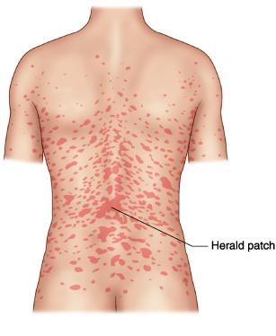 CSA 123 on X: "Pityriasis rosea can start as one herald patch and then form "Christmas tree" pattern http://t.co/3NVdIZoP3S”" / X