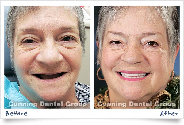 CunningDental's tweet image. Permanent Teeth in 1 Day Seminar Thursday 2/19/15 6:30 PM. Register Online bit.ly/1BEHi4i  #FixYourTeeth now