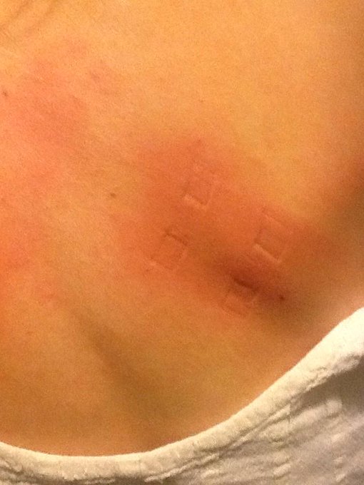 Clothespins on my back skin... Ow. I like my bondage superlight lol #clothespins #pain http://t.co/4<a href="/tag/pain"class="tags"><span>#pain</span></a><a href="/tag/clothespins"class="tags"><span>#clothespins</span></a>
