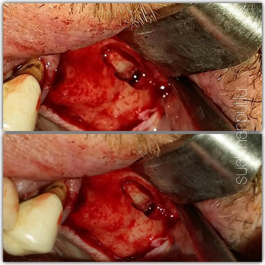 suatharputlu's tweet photo. Aspect of the chronic purulent #sinusitis when #sinuslifting.Theoperation was endded because of #purulence #dentistry http://t.co/XhXKe5jbH2