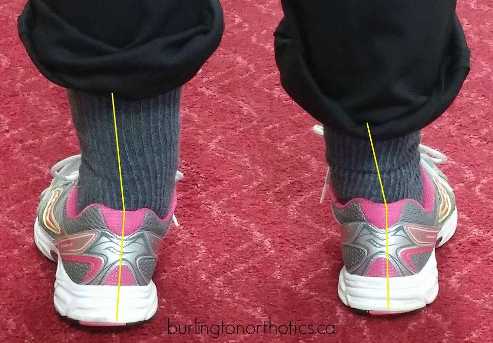 burlorthotics's tweet photo. If you see feet roll like this - they shouldn't! we can help. http://t.co/4KHsuMvDGK