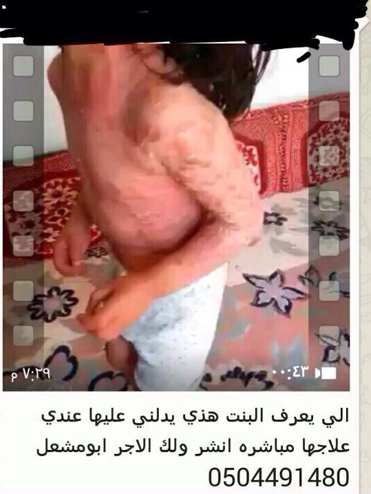 اللي يعرف هذي البنت يدلني عليها عندي علاجها مباشرة ولكم الاجر والثواب ٠٥٠٤٤٩١٤٨٠ابو مشعل الله يشفيها يارب

رتويت