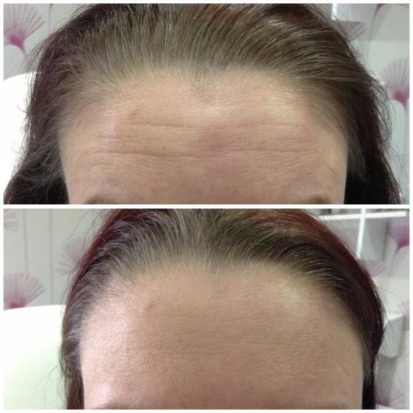 Precise_PMA's tweet image. This lady had Botulinum Treatment. it relaxes muscles and wrinkles rejuvenating skin. spabannockburn.co.uk