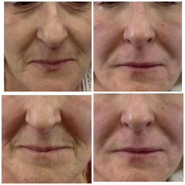 Precise_PMA's tweet image. 10 years younger? Dermal Fillers replace the loss of supportive tissues. On left were taken before, on right after.
