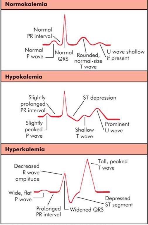 Interact On Twitter Hyperkalemia Hypokalemia Ecg Paramedic