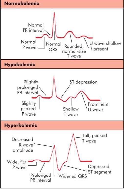 Hypokalemia Vs Hyperkalemia Ekg My Xxx Hot Girl