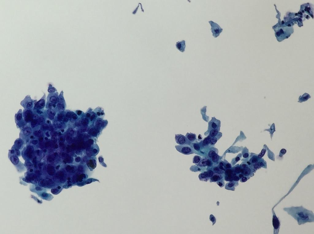 AnAtomicPath's tweet photo. Pitfall: ciliated bronchial cells R not always reassuring on EBUS #cytology | submucosal #squamousCA #pathologists http://t.co/ro7hbTomy7