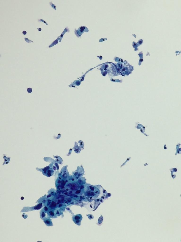 AnAtomicPath's tweet photo. Pitfall: ciliated bronchial cells R not always reassuring on EBUS #cytology | submucosal #squamousCA #pathologists http://t.co/ro7hbTomy7