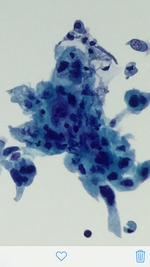 AnAtomicPath's tweet photo. Pitfall: ciliated bronchial cells R not always reassuring on EBUS #cytology | submucosal #squamousCA #pathologists http://t.co/ro7hbTomy7