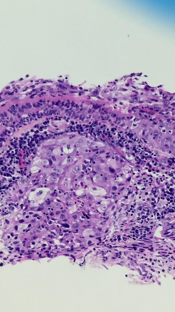 AnAtomicPath's tweet photo. Pitfall: ciliated bronchial cells R not always reassuring on EBUS #cytology | submucosal #squamousCA #pathologists http://t.co/ro7hbTomy7