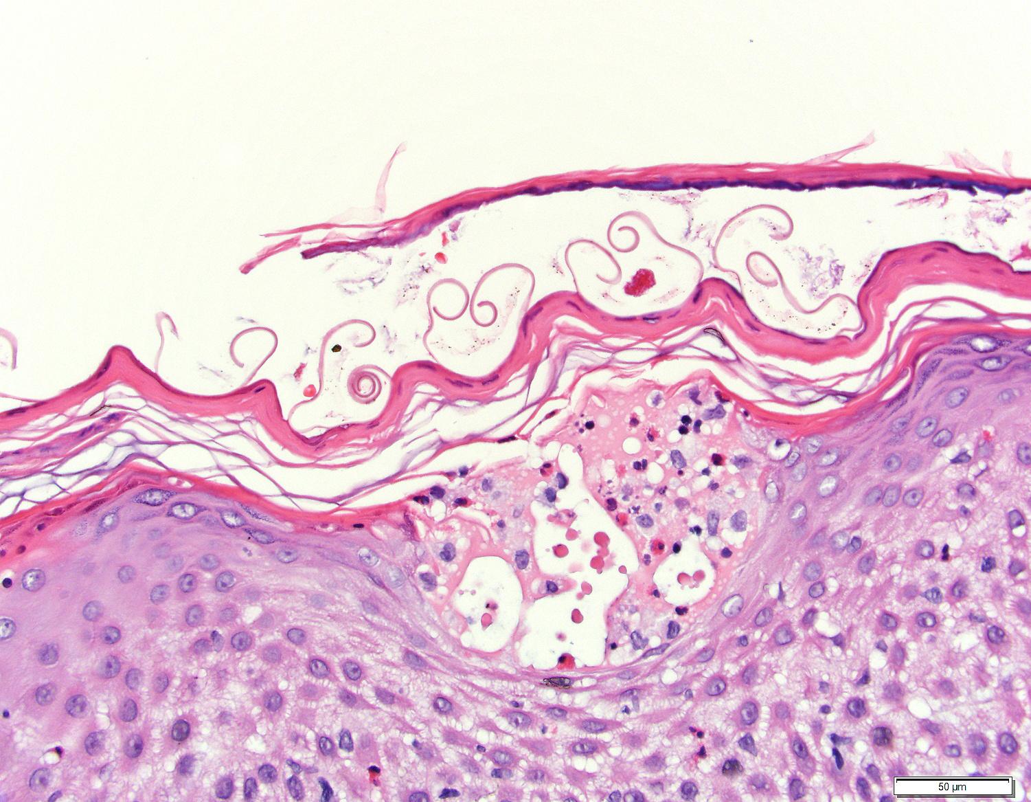 Pitted Keratolysis Histology