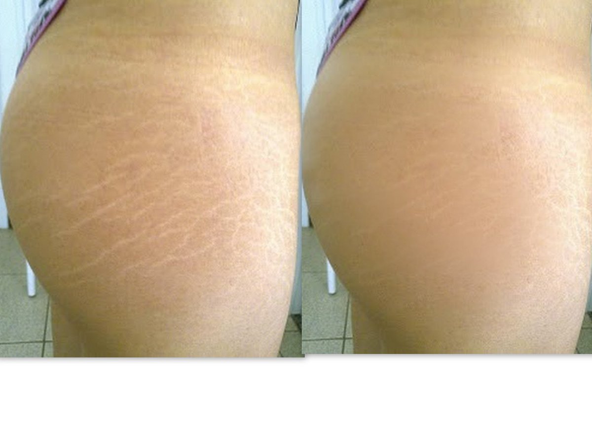 DEnterateYa's tweet photo. ¡DILE ADIÓS A LAS ESTRIAS! http://t.co/1x4idGZP6j http://t.co/HYBIvJByQF