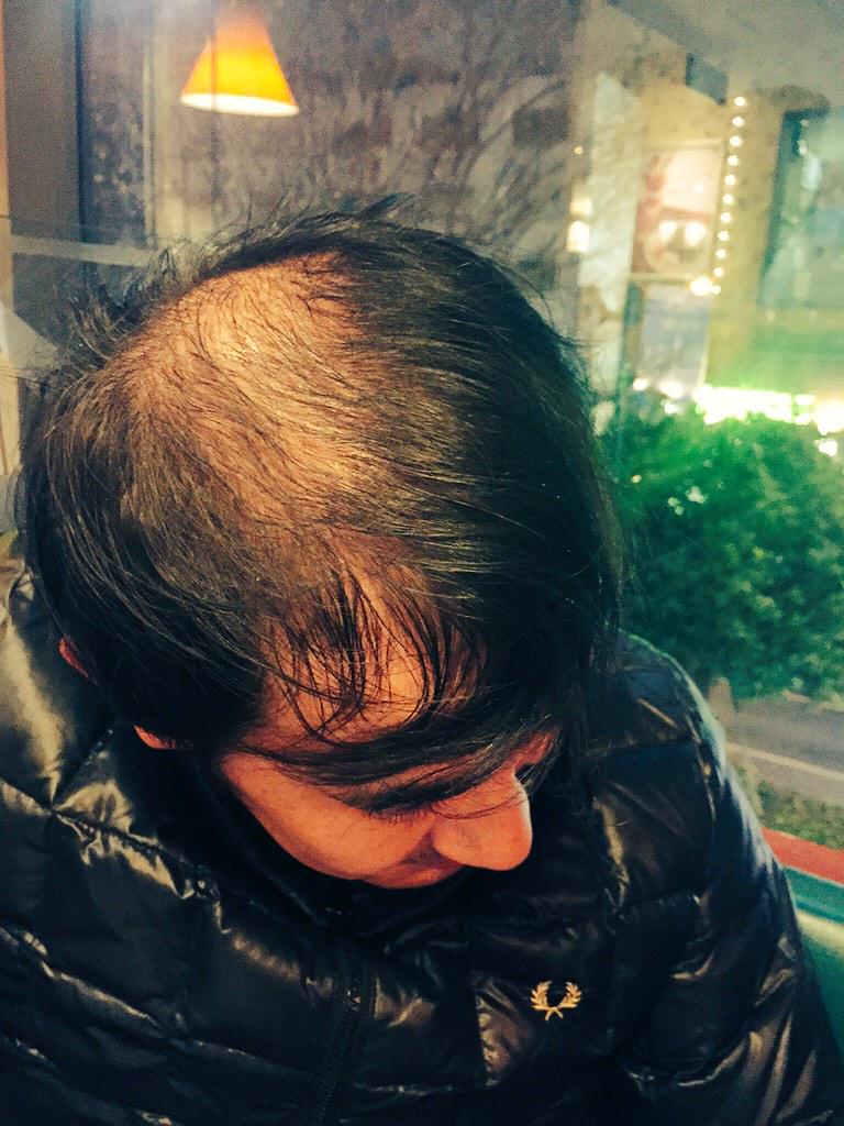 Twitter पर ハリウッドザコシショウ グロ注意 Rt Robinfoot Ogu 頭蓋骨見えてるよー Rt Zakoshisyoh はげてるなー Rt Ogu リンスフラーーッシュ Rt 1long リ リンス さん Http T Co Oszgupd6j4
