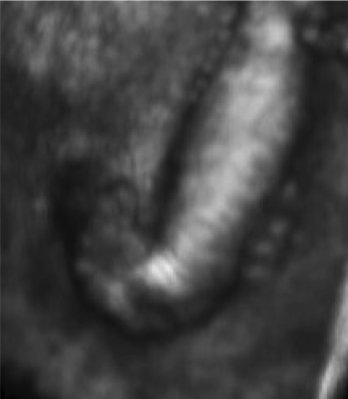 drlopezmartinez's tweet photo. Pie equinovaro congénito visto mediante ecografía 3D.Mala noticia para la madre pero buen resultado con tto precoz http://t.co/6h0FZSi75T