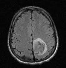 CanerOrgUa's tweet image. #Глиобластома - самая злокачественная опухоль головного мозга - cancer.org.ua/neurooncology/…

#новости #онкология #cancer