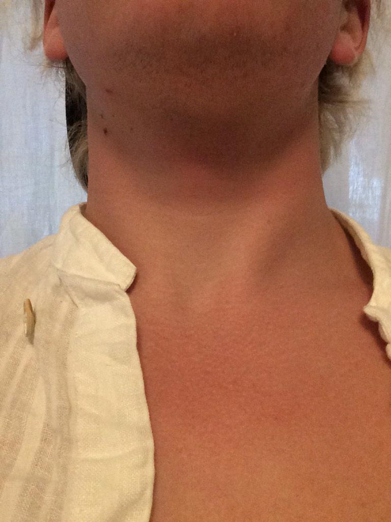 I've got a wetsuit sunburn.