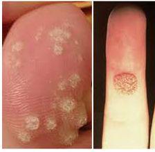 gregorhar's tweet photo. Don't let it spread! If you have a wart then don't let it get this bad before visiting http://t.co/QQxAhgX1wT http://t.co/jhMLb81ajs