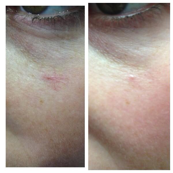 Precise_PMA's tweet image. IPL effectively gets rid of unsightly broken veins leaving your skin rejuvenated. spabannockburn.co.uk