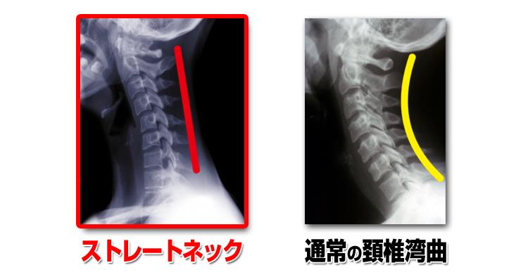 100rt：【要注意】小指変形よりも怖いスマホ病「ストレート ...