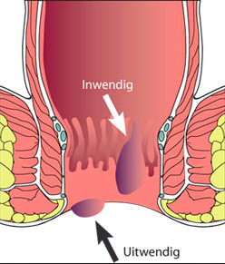 PoepGoed's tweet image. “@darmgezondheid: Aambeien: wat zijn het en hoe kom je er vanaf?

darmgezondheid.nl/consumenten/da… http://t.co/YlISiQI37A”