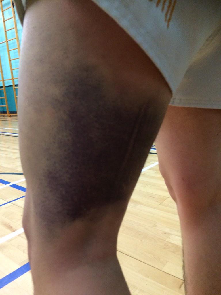 StrathMMA's tweet image. Don't forget training tomorrow night. 5pm start. Leg kicks again. Let's see if anyone can beat this bruise..
