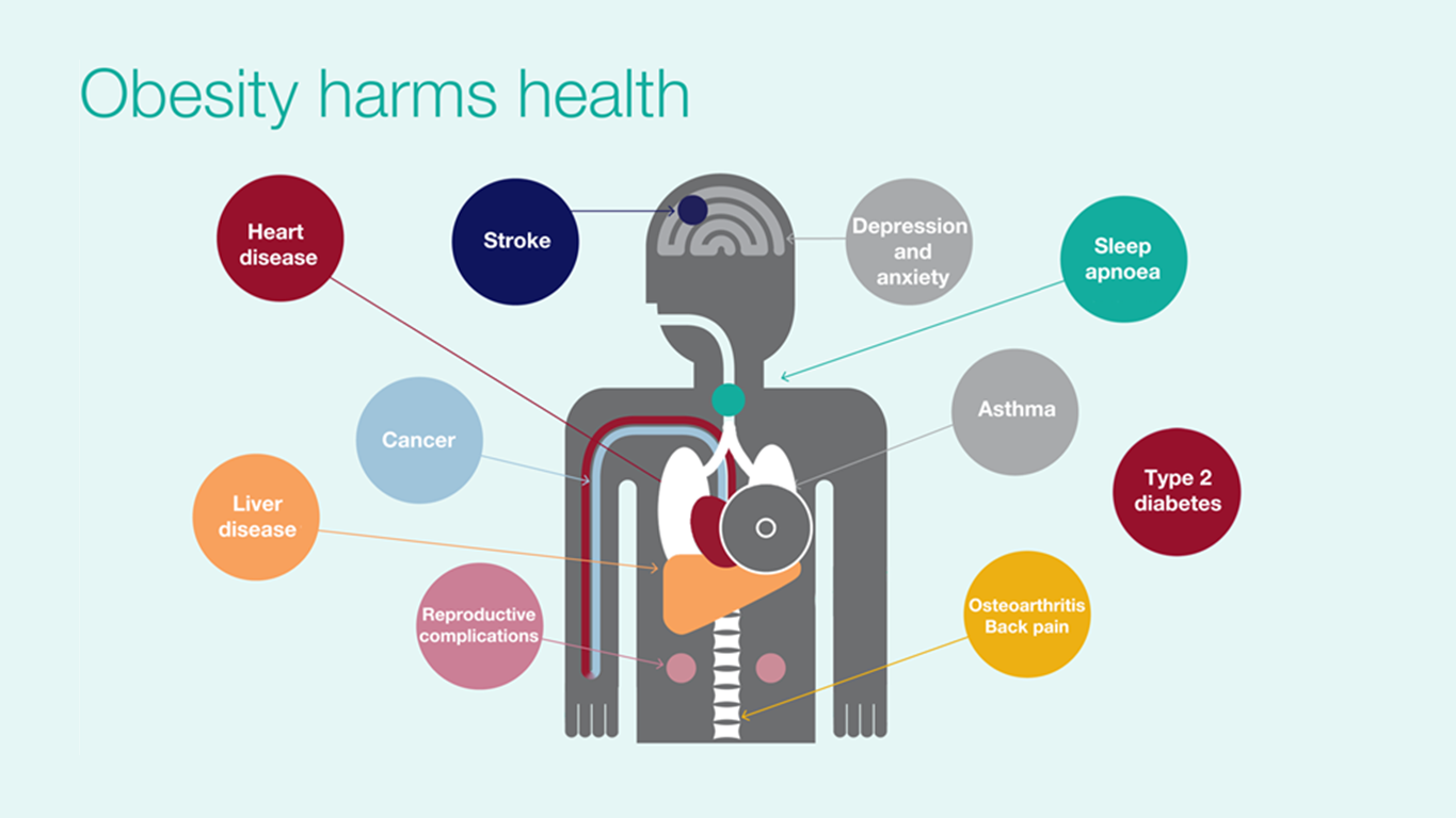 Public Health Issues. Obesity illness. Obesity Issues. Causes of obesity.