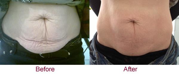 Beth_Pedley's tweet photo. #beachbody #back #scars #stretchmarks #acne #follow #link #order #information #best #results http://t.co/FomQScEMPj http://t.co/wuwBaiCghW