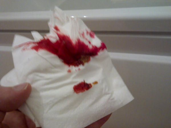 DaveTheRave27's tweet photo. @DoctorChristian I'm the bat man guy in magaluff!! I wiped my arse and it looked like this is it normal? http://t.co/xTz0v8jv