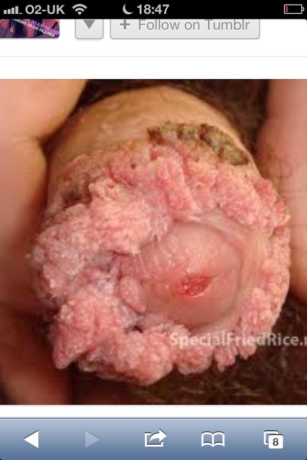 herpes on hands picture #11