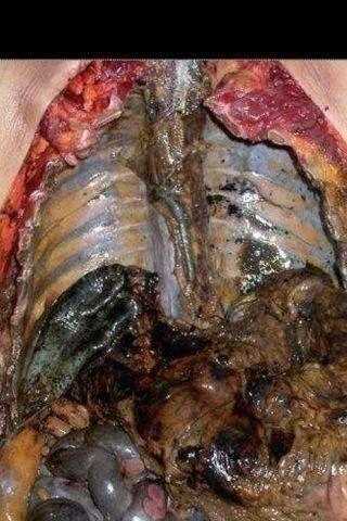 هذا مايحصل في جسم المدخن اسأل الله لهم ان يهديهم منه ويعافي مريضهم والله انها صوره تقشعر لها الأبدان أنقذوا أجسادكم