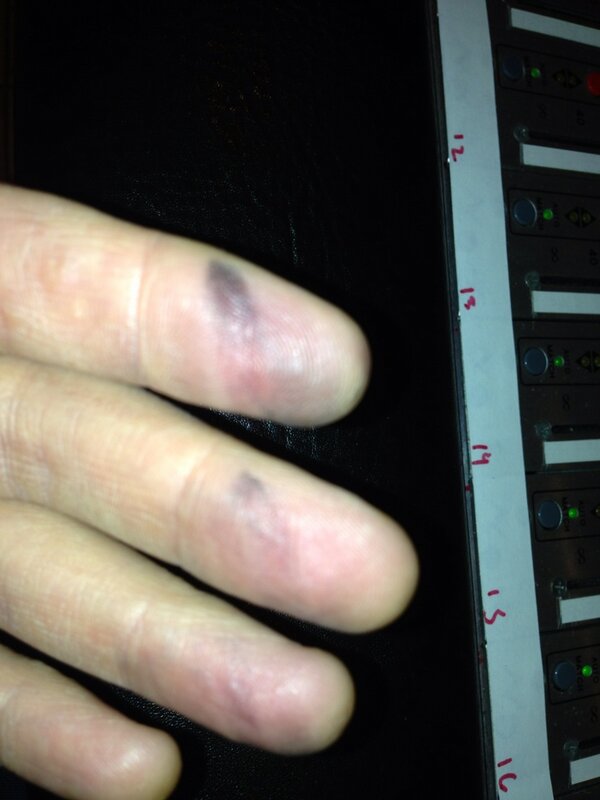 Bruise Bruise