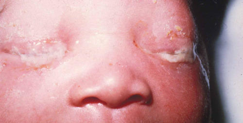 Neonatal conjunctivitis: MedlinePlus Medical Encyclopedia