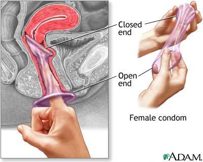 blogdokter's tweet image. Kondom wanita bentuknya seperti ini: #kondom