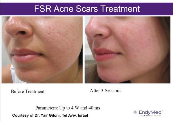 facials for acne scars